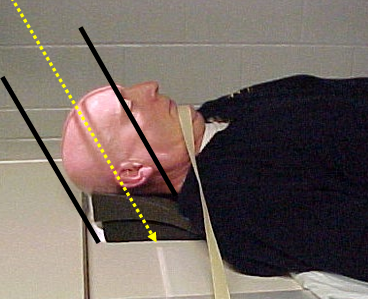 <ul><li><p>25 caud, does not pass through EAM</p></li><li><p>midway between vertex and supraorbital rims</p></li><li><p>vertex → supraorbital rims *exclude eyes* </p></li></ul><p></p>