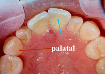 palatal surface for upper teeth
