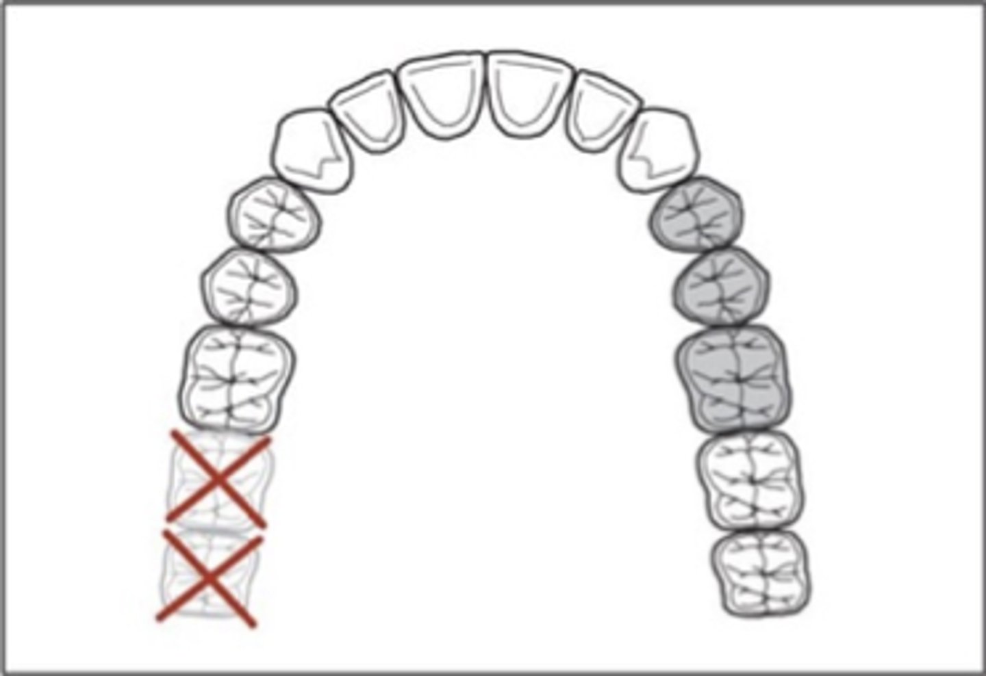 <p>Applegate’s Rules:</p><p>Rule 4. If a ______molar is missing and is not to be replaced, it is not considered in the classification (e.g., if the opposing second molar is likewise missing and is not to be replaced).</p>
