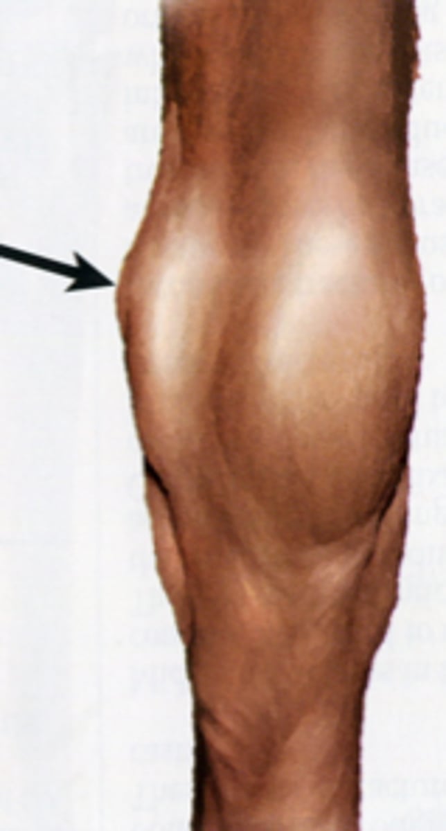 <p>Tenosynovitis of the tarsal sheath</p><p>Soft, puffy area of hock caused by trauma or tendon strain</p><p>Excess buildup of synovial fluid</p><p>TX: Pressure and massage of area</p>