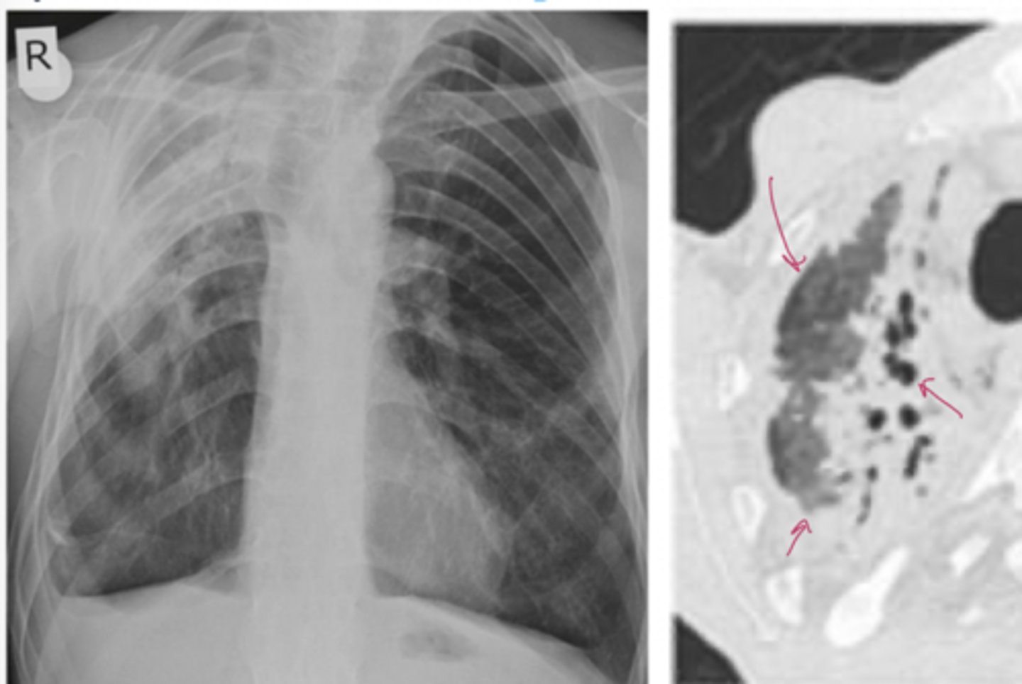 <p>A 41-year-old man presents with progressive shortness of breath and chronic dry cough over the past year. He denies fever or sputum production. Symptoms have been slowly worsening and are now limiting his exercise tolerance.</p><p>His history is notable for long-standing low back pain and morning stiffness since his 20s, which improves with activity. He also reports reduced spinal mobility over time.</p>