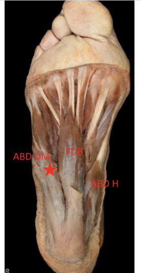 <p>Abductor digiti minimi </p>