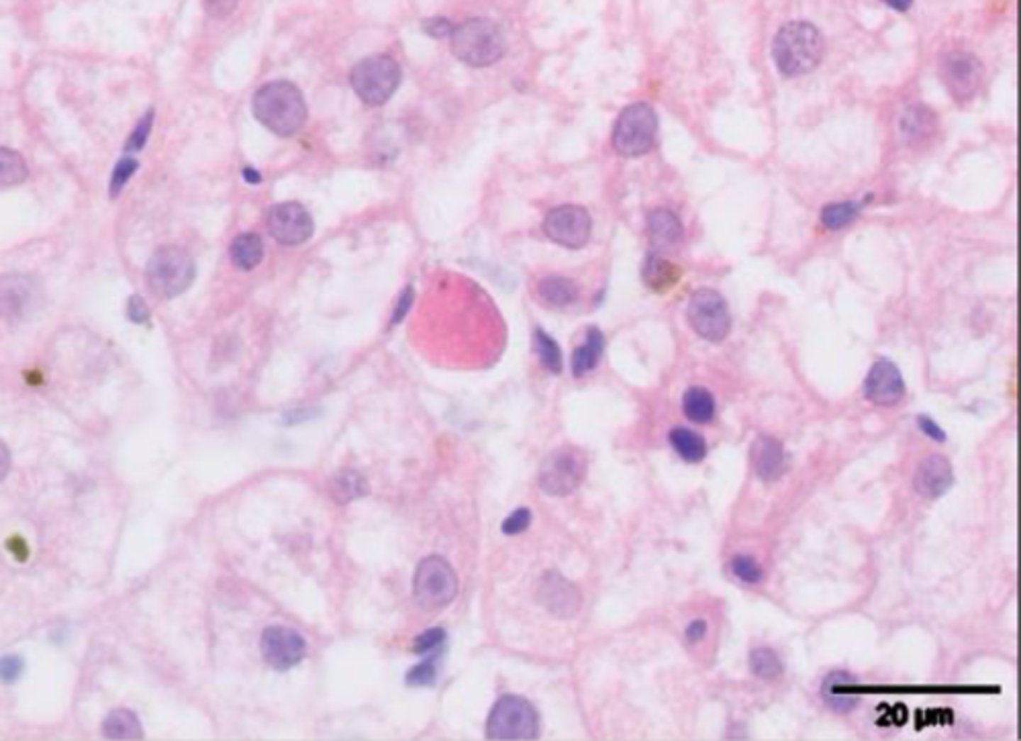 <p>Immune mediated disease (chronic interface hepatitis), certain toxins, certain infections</p>