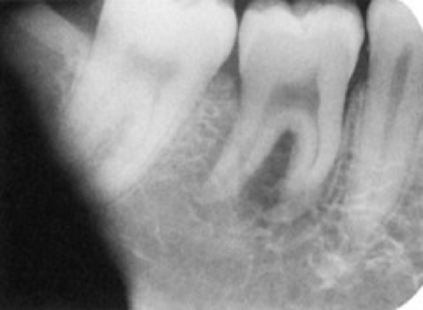 <p>-Exposing film to white light, prior to processing, that portion of the image will appear black</p>