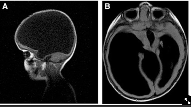 <ul><li><p><span>Congenital absence of&nbsp; cerebral hemispheres replaced by hugely dilated ventricles</span></p></li><li><p><span>Causes –</span></p><ul><li><p><span>Infarction (stroke) due to occlusion of internal carotid arteries in uterus</span></p></li><li><p><span>Severe necrotizing encephalitis in uterus from Toxoplasma, Rubella, Cytomegalovirus, or Herpesvirus (TORCH)&nbsp;</span></p></li></ul></li></ul>
