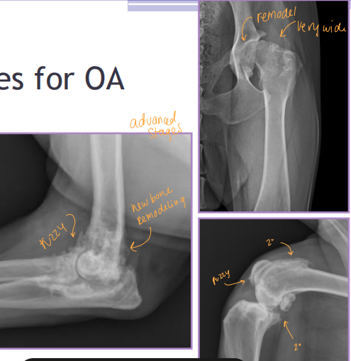 <p><span style="background-color: transparent;"><strong><span>Pathogenesis of Osteoarthritis</span></strong></span></p>
