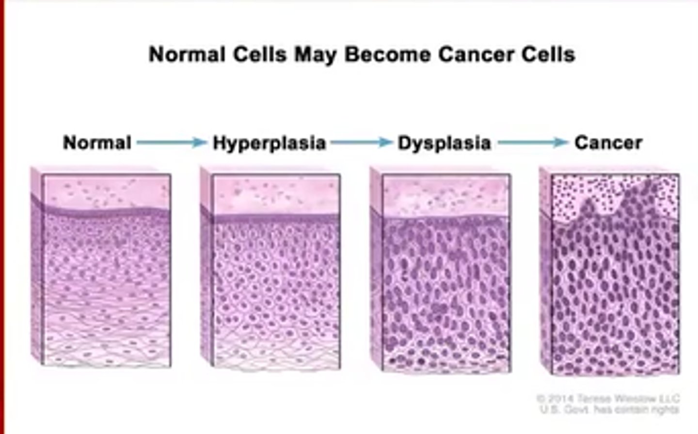 <p>normal->hyperplasia->dysplasia->cancer</p>