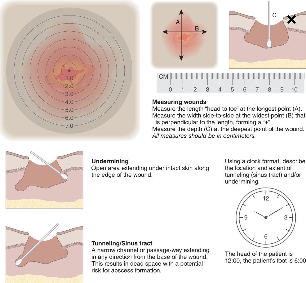 A sterile premoistened cotton tip applicator 
