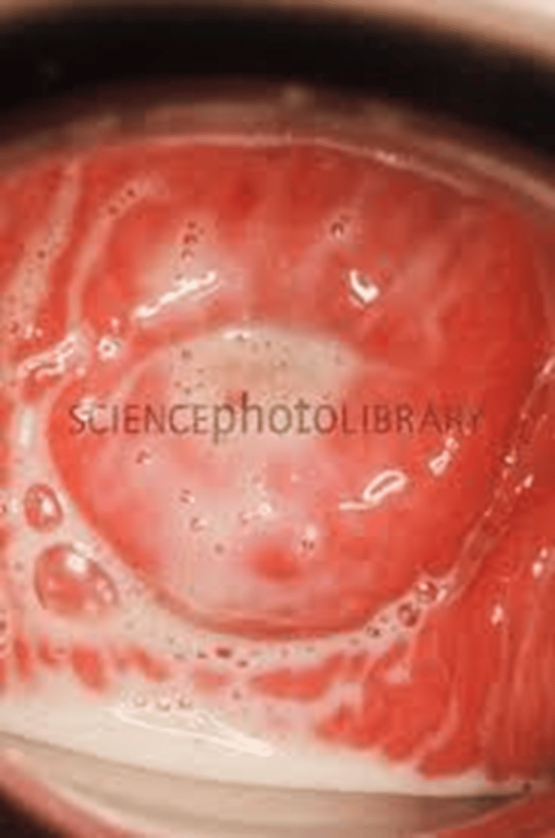 <p>smells like fish, copius discharge, bleeding or spotting, tx flagyl</p>