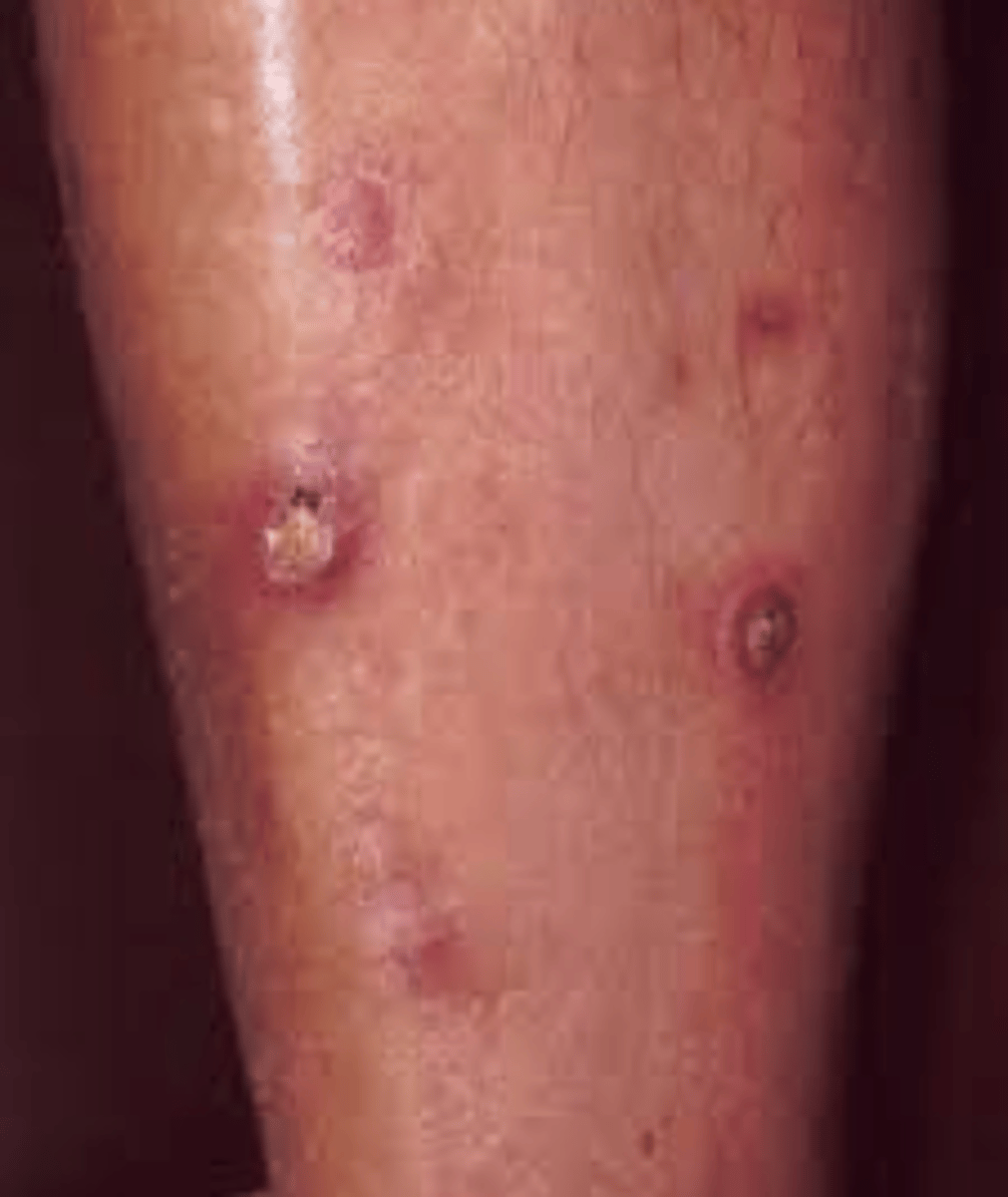 <p>reacting perforating collagenosis<br>-puritic papules with keratotic plug on extensor surfaces with legs most commonly; associated with kidney disease</p>