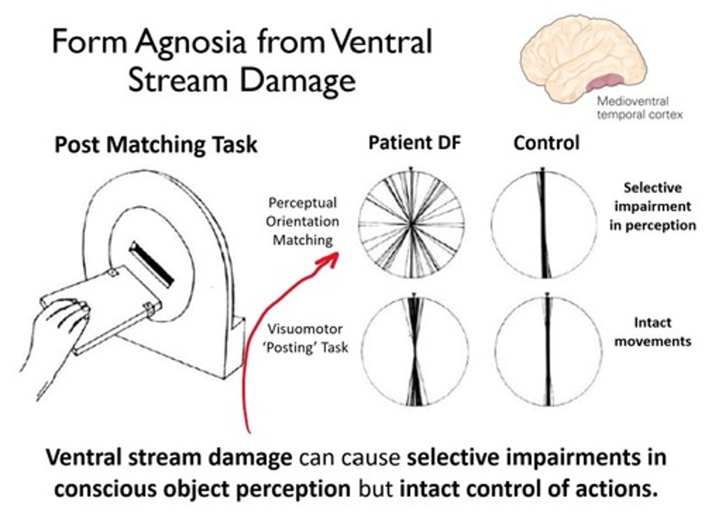 <p>Occipital Damage and Visual Agnosia <br>Visual agnosia is the inability to recognize objects or pictures of objects—or the inability to draw a copy of the objects<br>Patients with carbon monoxide poisoning leading to damage to area LO have visual form agnosia and cannot recognize line drawings of objects<br>Patients cannot draw pictures of objects when looking at them and cannot reproduce line drawings<br>No difficulty reaching for and grasping objects, even though they cannot recognize them<br>Unable to correctly judge lines as horizontal or vertical, but can orient movements to match horizontal or vertical lines<br>Results suggest that the dorsal stream is intact (guiding movements to a target), but the ventral stream is not (recognizing objects).</p>
