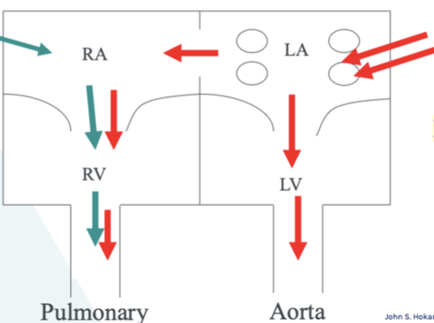 <p>Fixed split S2 and pulmonary flow murmur</p><p>RA, RV, MPA enlarged</p>