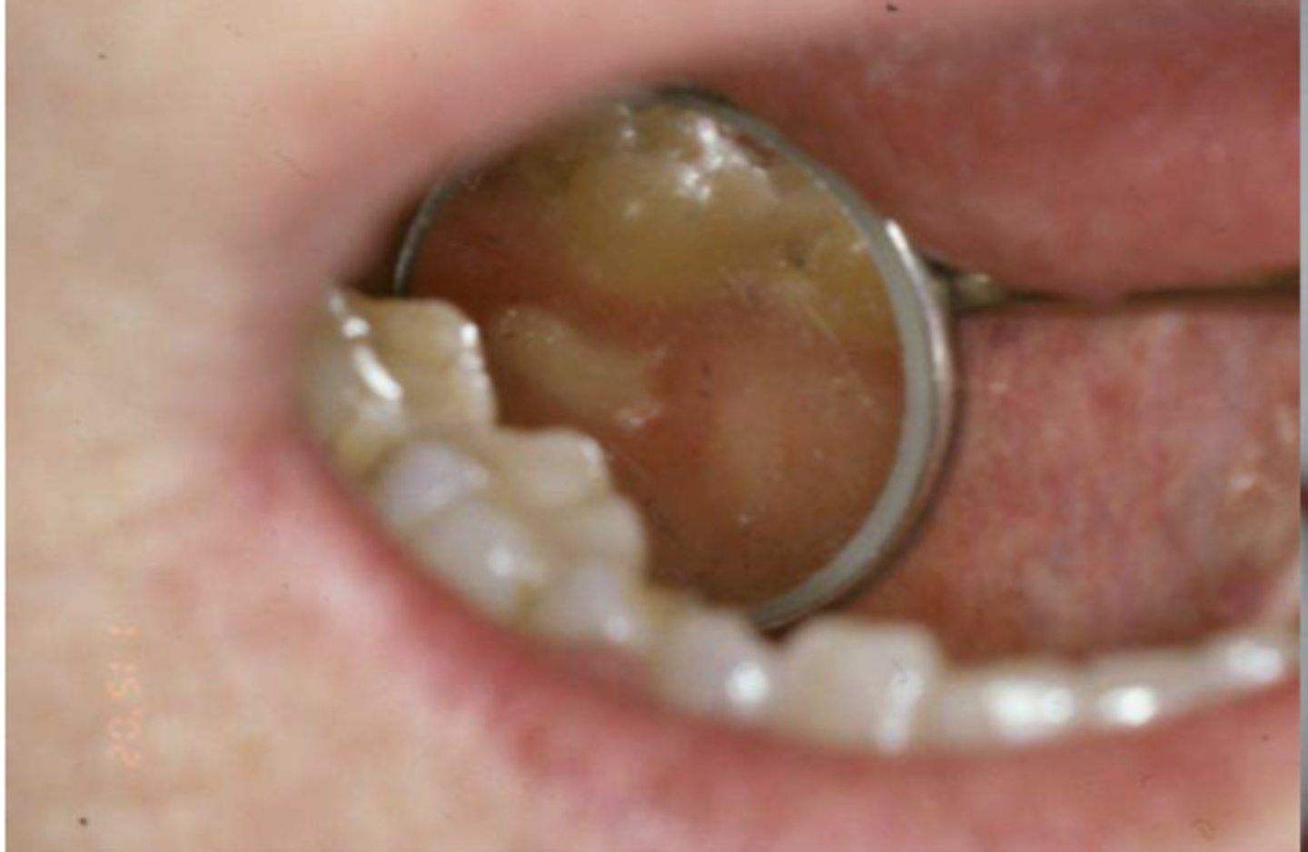 <p>Patient was diagnosed with Paget's disease 6 mo ago and began anti-resorptive therapy upon diagnosis. What do you suspect this lesion is?</p>