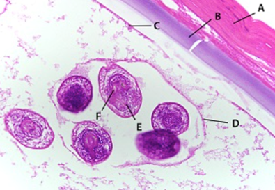 State A (it encapsulates the hydatid cyst wall)
