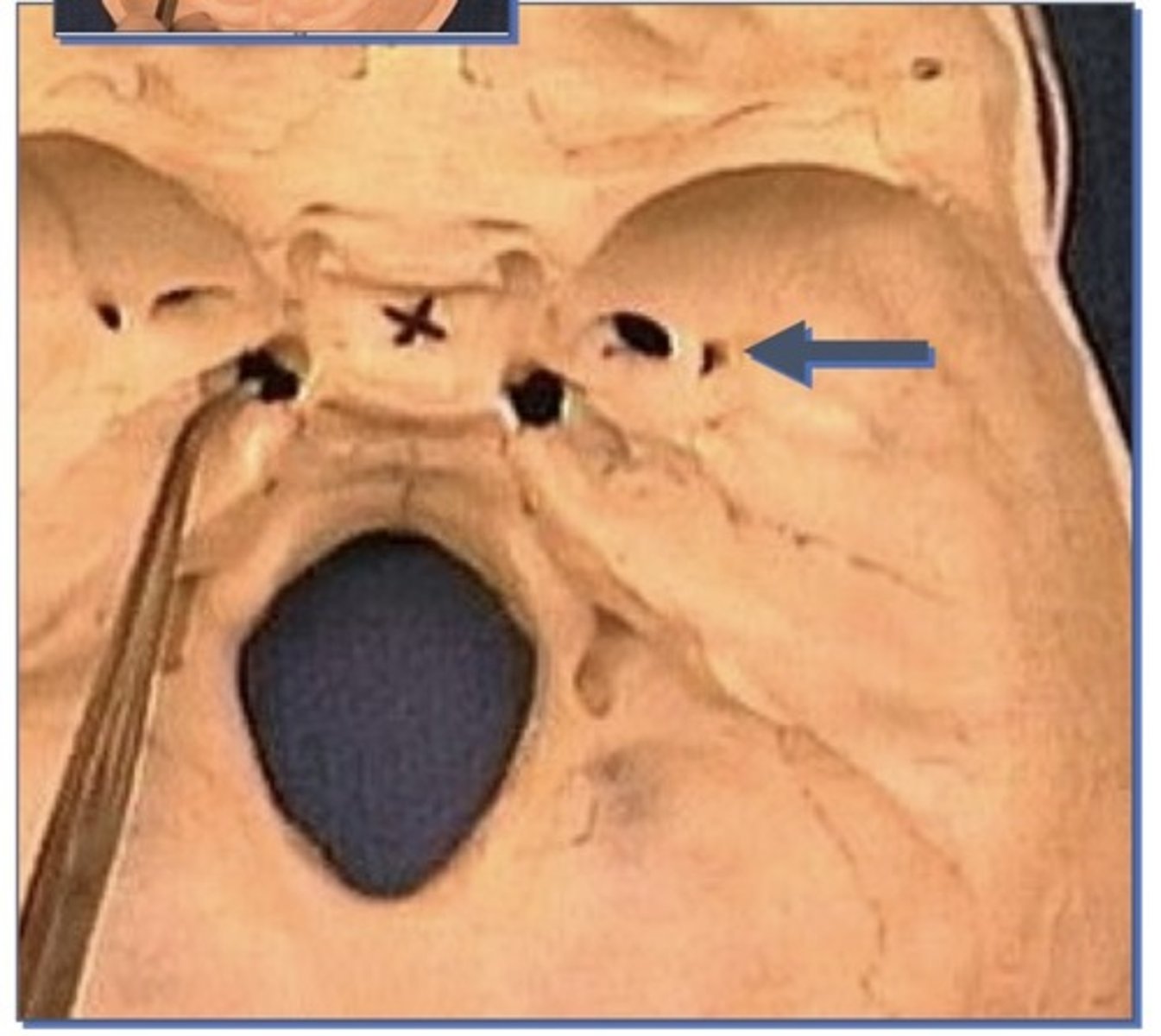 <p>1. Small opening immediately lateral to Ovale</p><p>2. In sphenoid bone</p><p>3. Next to sphenoid spine</p>