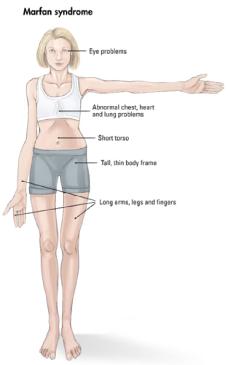 <p>connective tissue disorder caused by a mutation in the gene that encodes fibrillin-1, which is essential for elastin maintenance</p><p>- affects the aorta, ligaments, and eyes</p><p>- patients tend to have a tall stature, scoliosis, abnormal joint mobility, and hyper-extensibility of hands, feet, elbows, and knees</p>