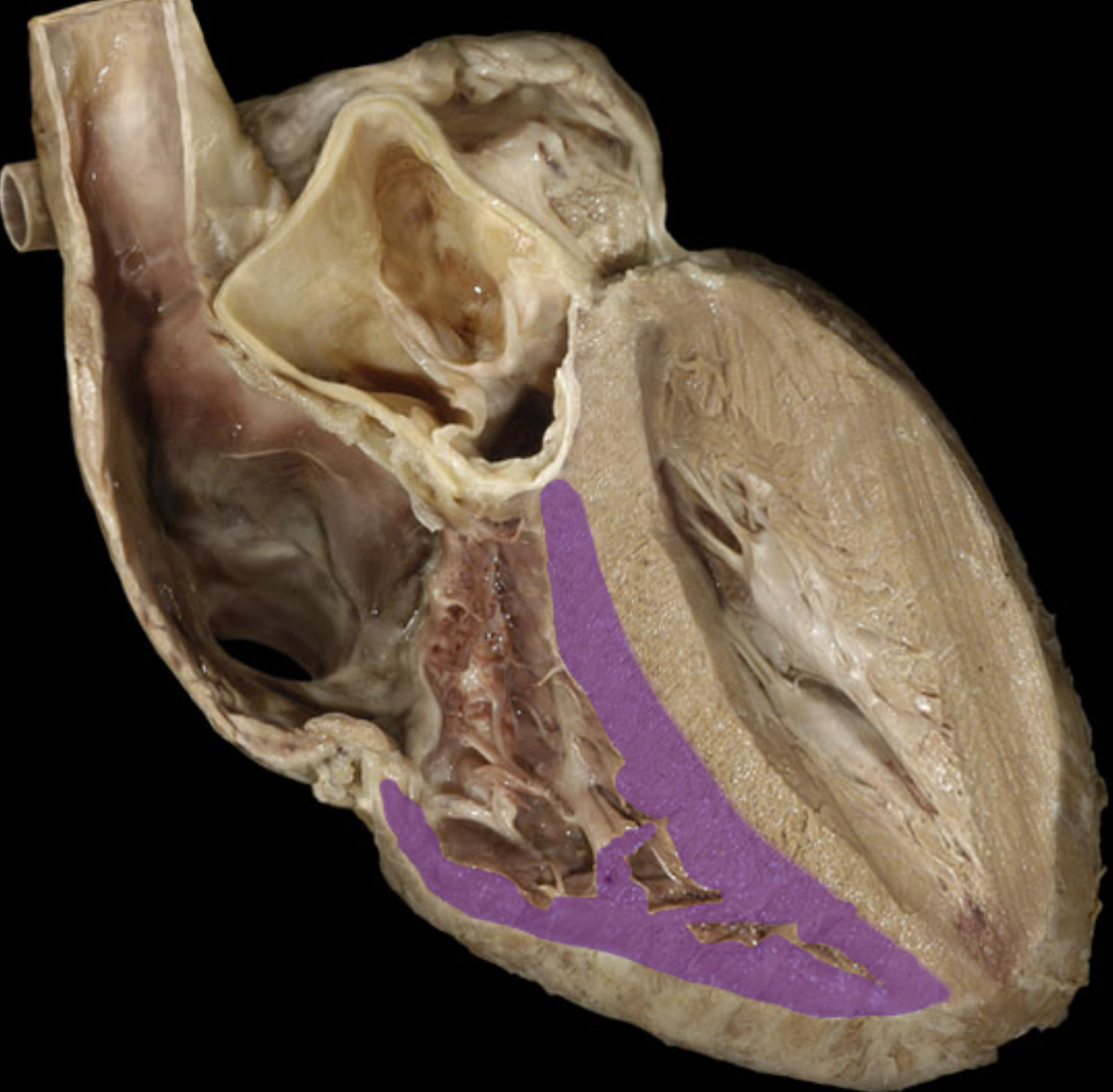 <p>Myocardium of right ventricle </p>