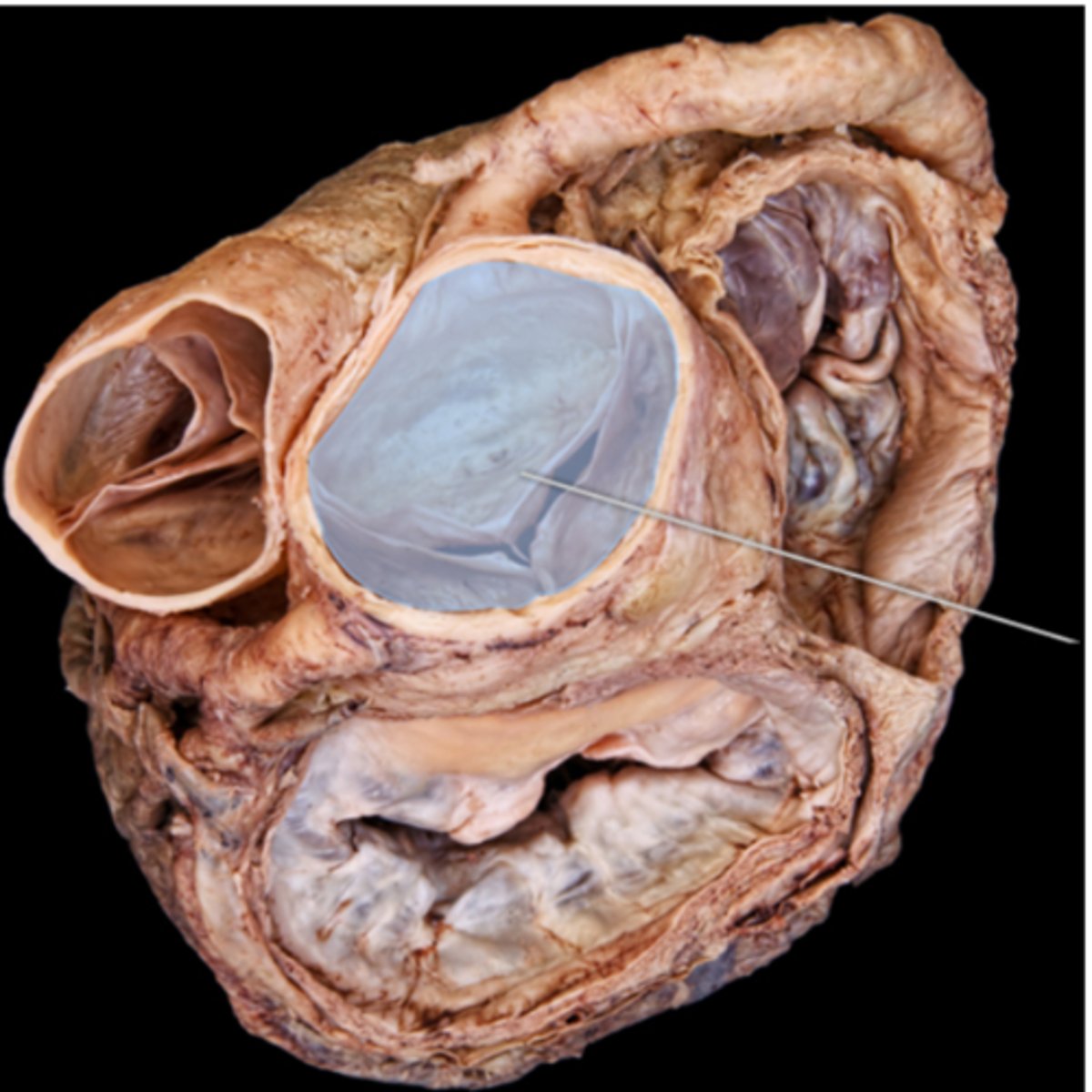 <p>aortic semilunar valve</p>