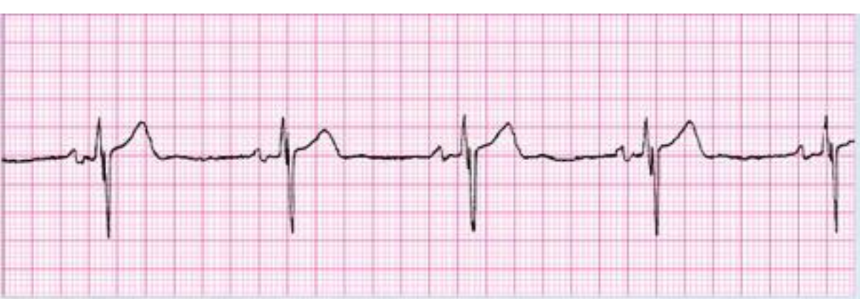 ekg rhythms Flashcards | Knowt