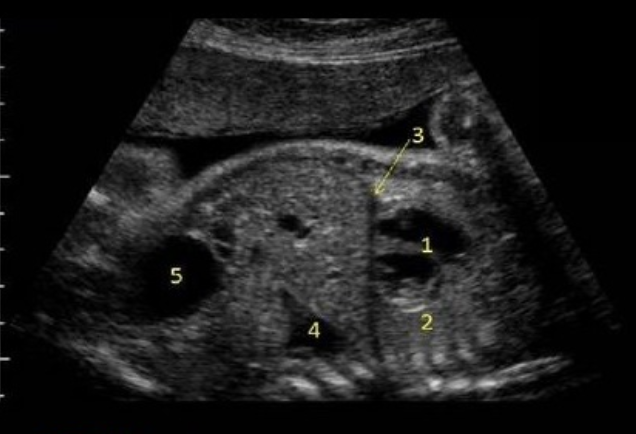<p>what is #4</p><p>a) hydronephrosis</p><p>b) bladder</p><p>c) stomach</p><p>d) lung tissue</p>