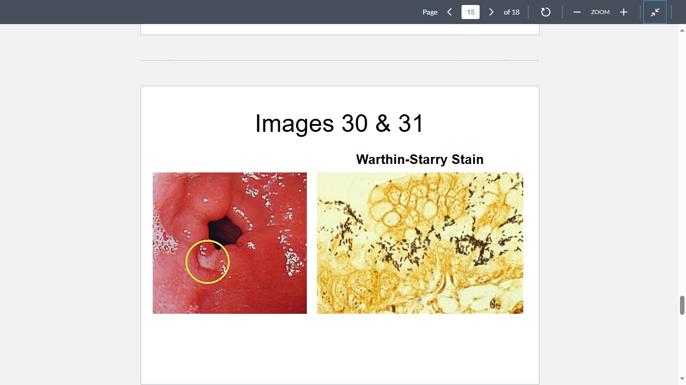 <p>A 35-year-old man presents with an epigastric pain, relieved by food intake. Endoscopy reveals numerous lesions in the gastric mucosa (Image 30). Biopsy of the adjacent tissue reveals the following organisms (Image 31)</p><p></p><p>What is the most likely cause?</p>