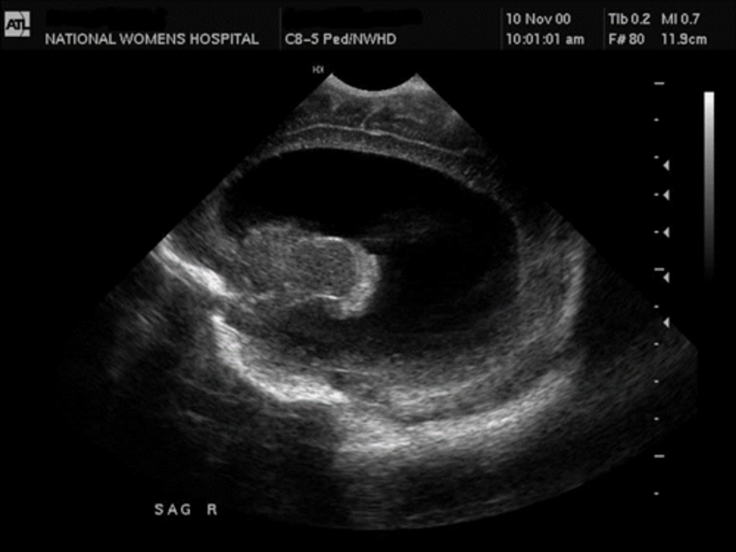 <p>Excess CSF in brain, lateral ventricles &gt;15 mm, causeshead enlargement. Can be caused by spina bifida and other neural tubedefects, in utero infections</p>