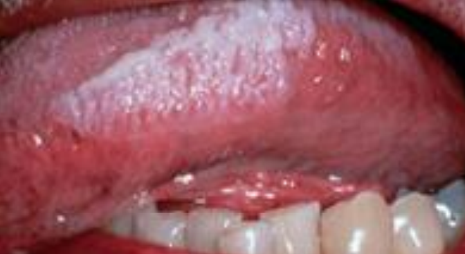Hairy leukoplakia