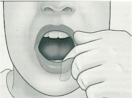 <p>Uses index finger (detect presence of exostosis on the mandible)</p>