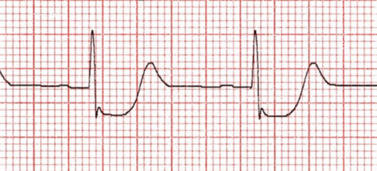 <p>Depressed ST segment</p>