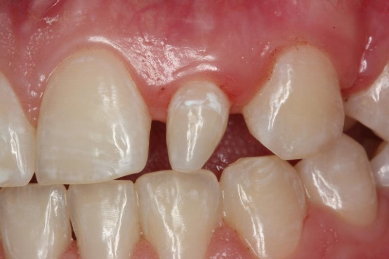 <p>peg laterals</p>