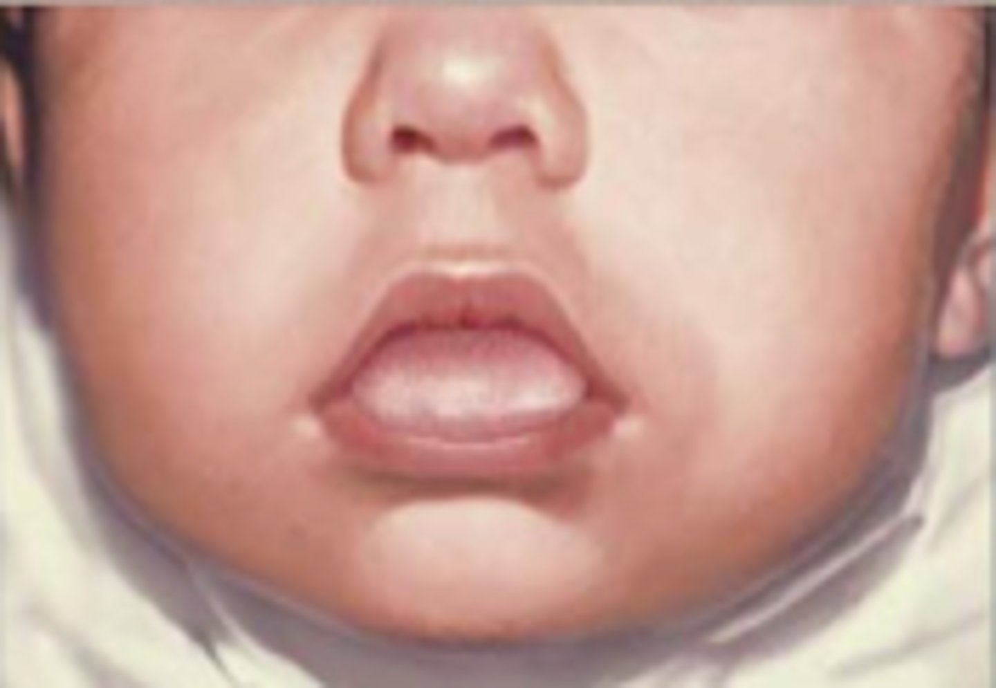 <p>enlarged tongue</p>