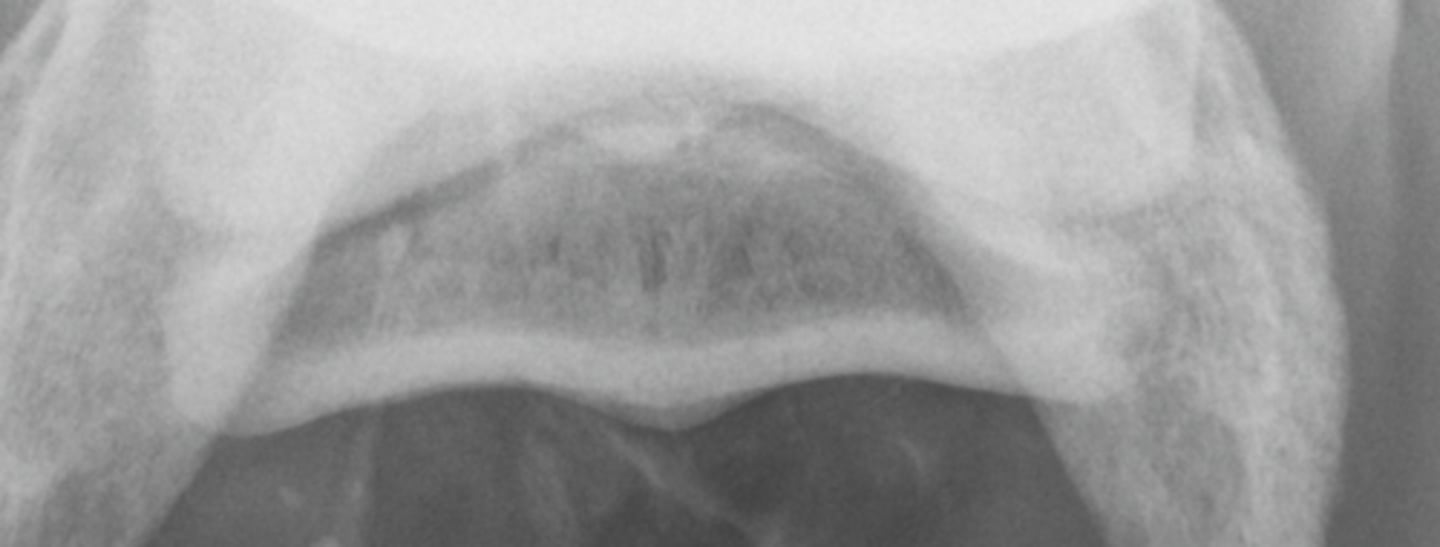 <p>What is highlighted in a navicular skyline view?</p>