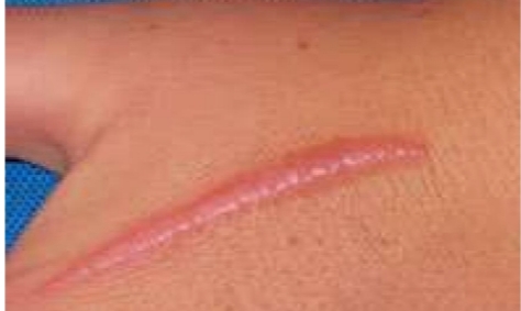 <p>What type of tissue repair outcome is shown?</p>