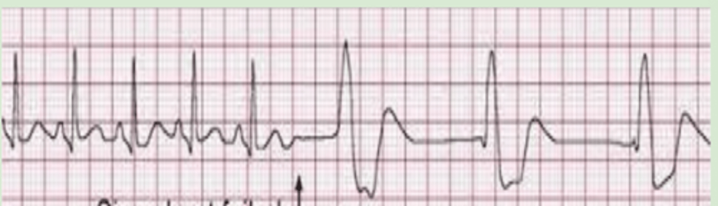 <p>Failure of the sinus node → brief pause → takeover of rhythm by focus in the ventricle</p>