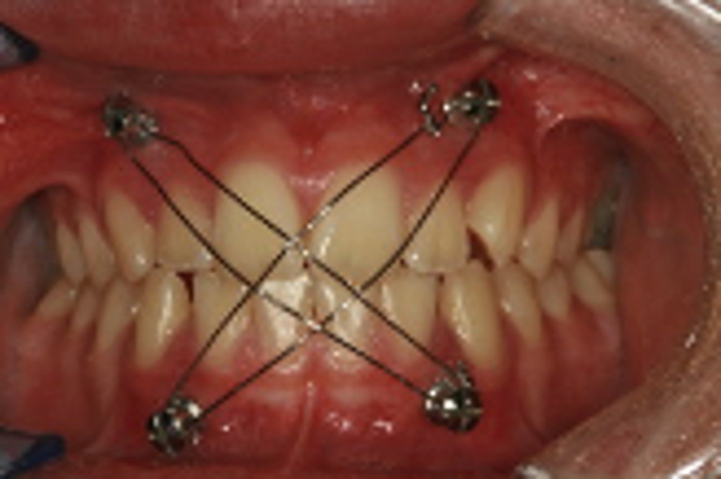 <p>ID the closed treatment/ maxillomandibular fixation:</p><p>•Screw directly into the bone</p><p>•Typically not used for extended periods (usually intraoperative only)</p>