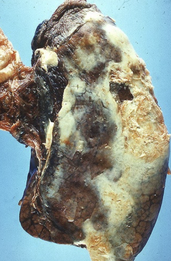 <p>pus in pleural space</p>