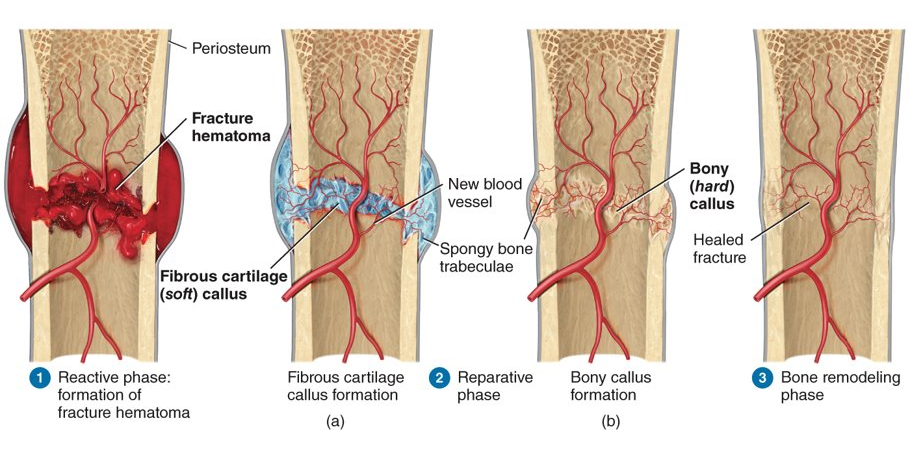 <p>reactive phase (early inflammation), fibrocartilaginous callus reparative phase and bony callus reparative phase, and bone remodeling phase</p>