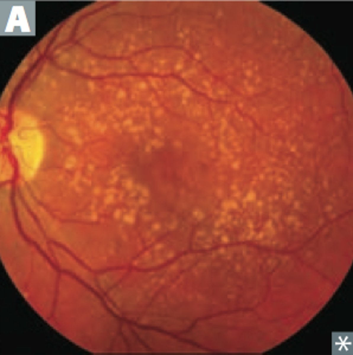 <p>d. age-related macular degeneration (ARMD)</p>