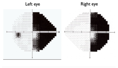<p>describe the location of this lesion &amp; the most probable cause</p>