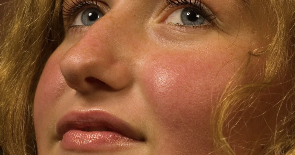 <p>occurs with the vessels of skin dilate and bring a surge of blood flow</p>