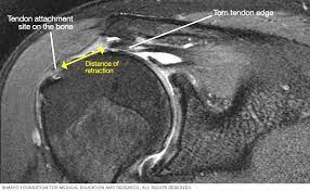 <p>the rotator cuff of the shoulder is a musculotendinous structure composed of the teres minor, infraspinatus, supraspinatus, and subscapularis muscles. insert mri image</p>