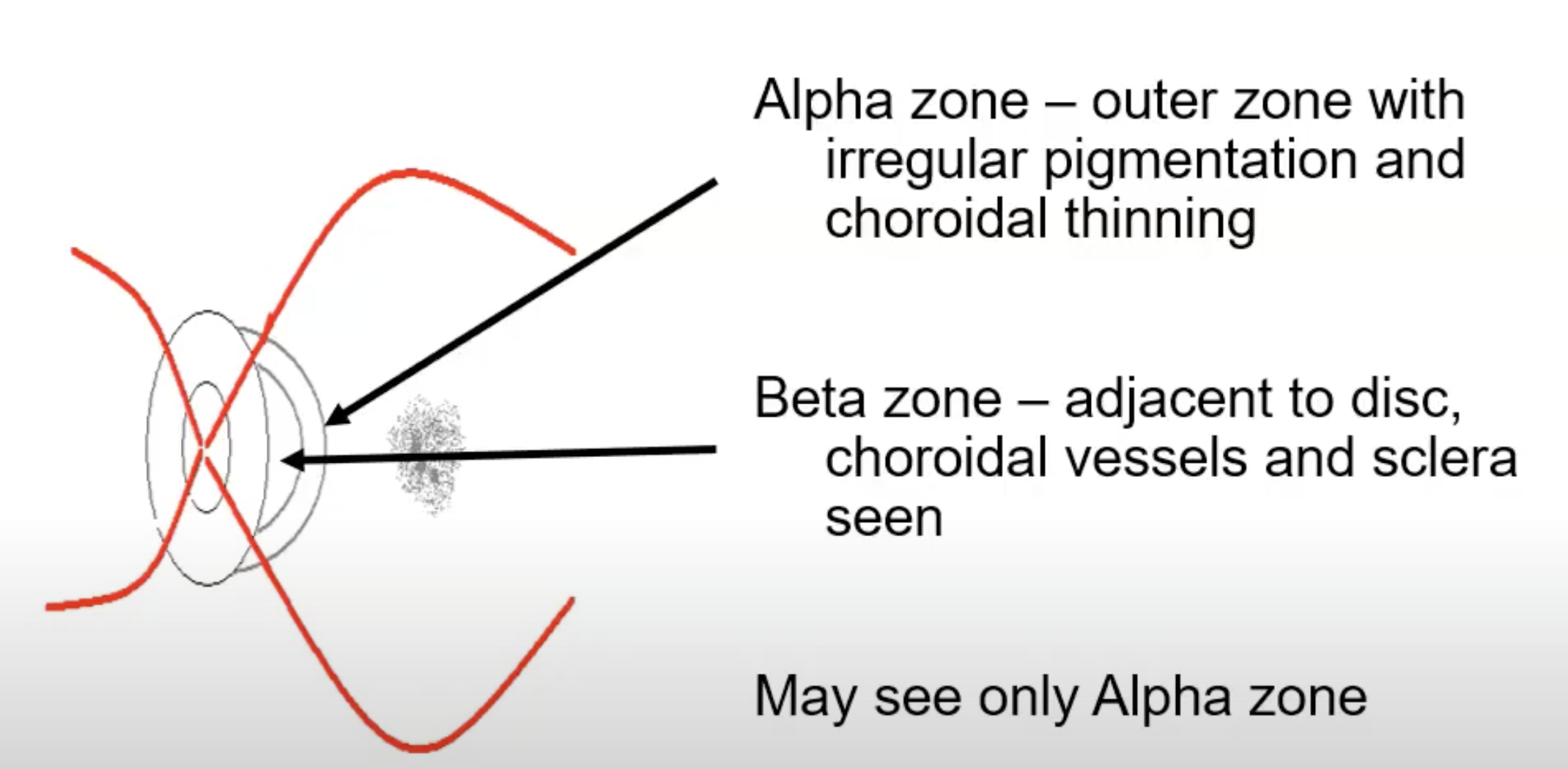 <p>zones of peripapillary atrophy</p>