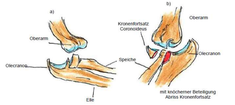 <p>Ellenbogenluxation</p><ul><li><p>distale Oberarm springt aus Ellenhaken raus</p></li></ul><p></p>