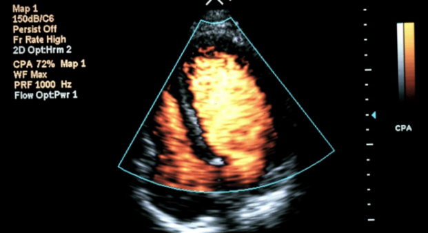 <p>using high MIs (mechanical indices) results in a contrast-to-tissue ratio improvement over standard MI B-mode harmonic imaging</p>