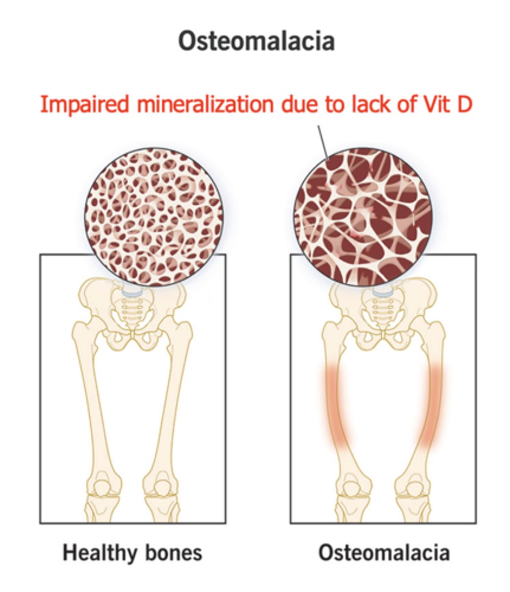 <p>Osteomalacia</p>