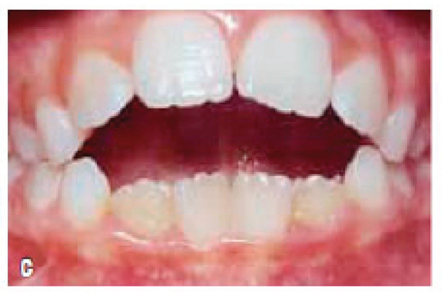 <p>Lack of incisal contact</p><p>Posterior teeth in occlusion</p>