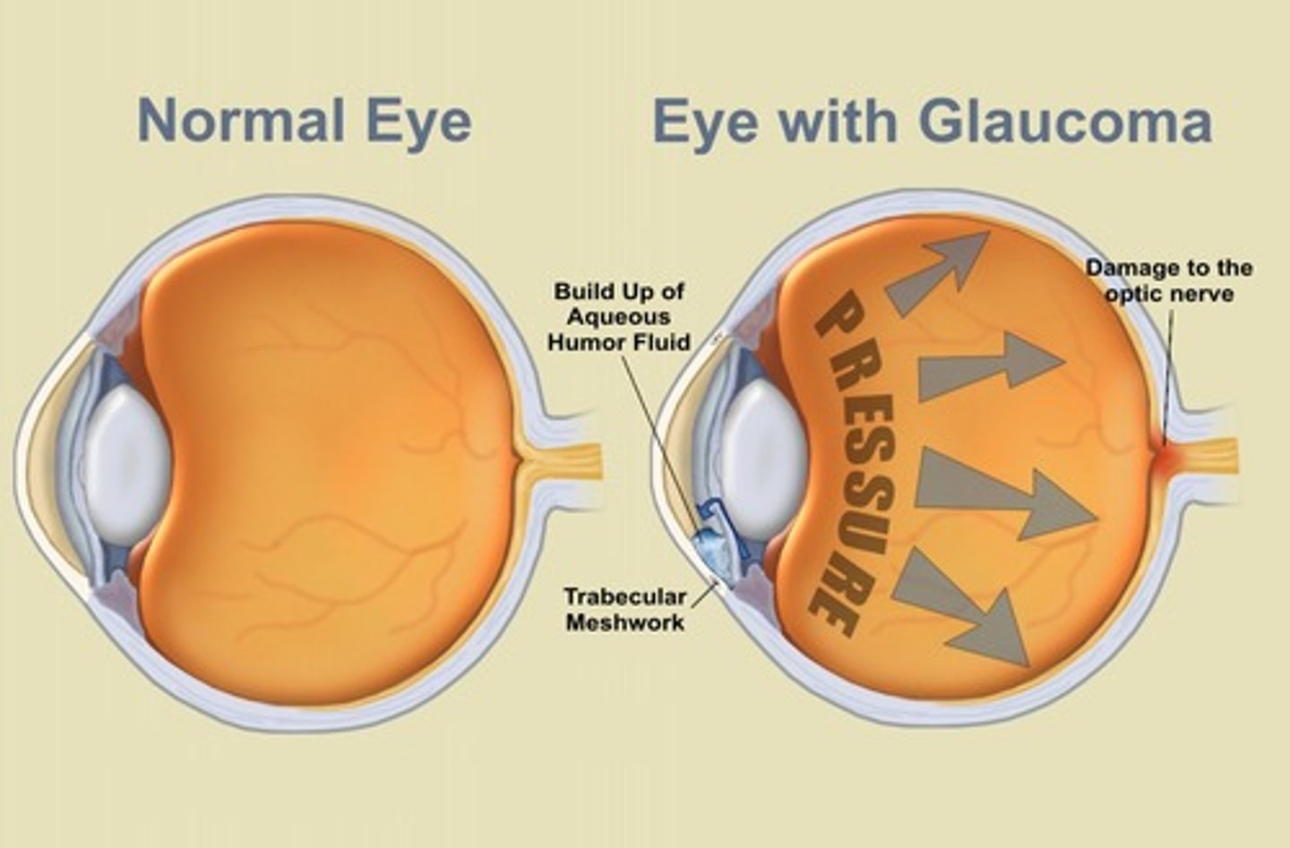 <p>a condition of increased pressure within the eyeball, causing gradual loss of sight.</p>