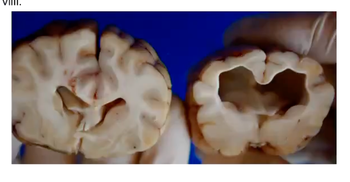 <p><strong>• Abnormal flow or absorption of CSF = accumulation of CSF w/in cranial cavity = reduce thickness of cerebral cortex.</strong></p><ul><li><p>The most common brain malformation.</p></li><li><p>Excess CSF due: stenosis (absent) or small size of mesencephalic aqueduct, increased CS production from choroid plexus, abnormal CSF absorption due malformed/lack of arachnoid villi.</p></li></ul><p></p><p>**** Although there also exist acquired causes of hydrocephallus, these are typically congenital </p>