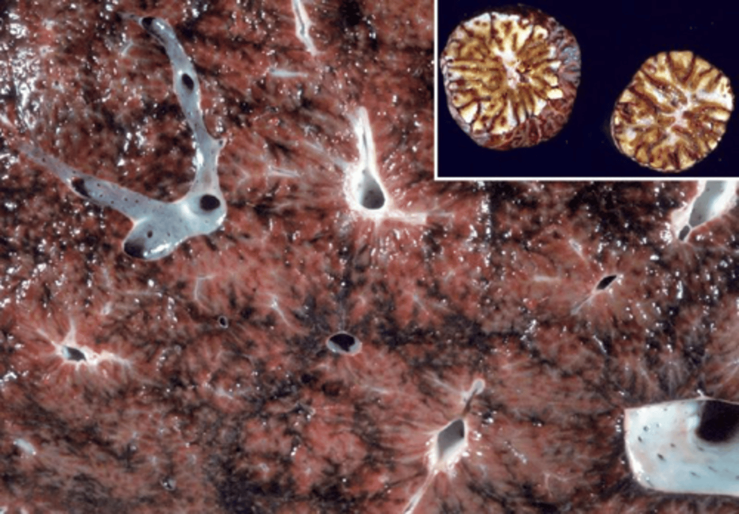 <p>Nutmeg liver.</p>