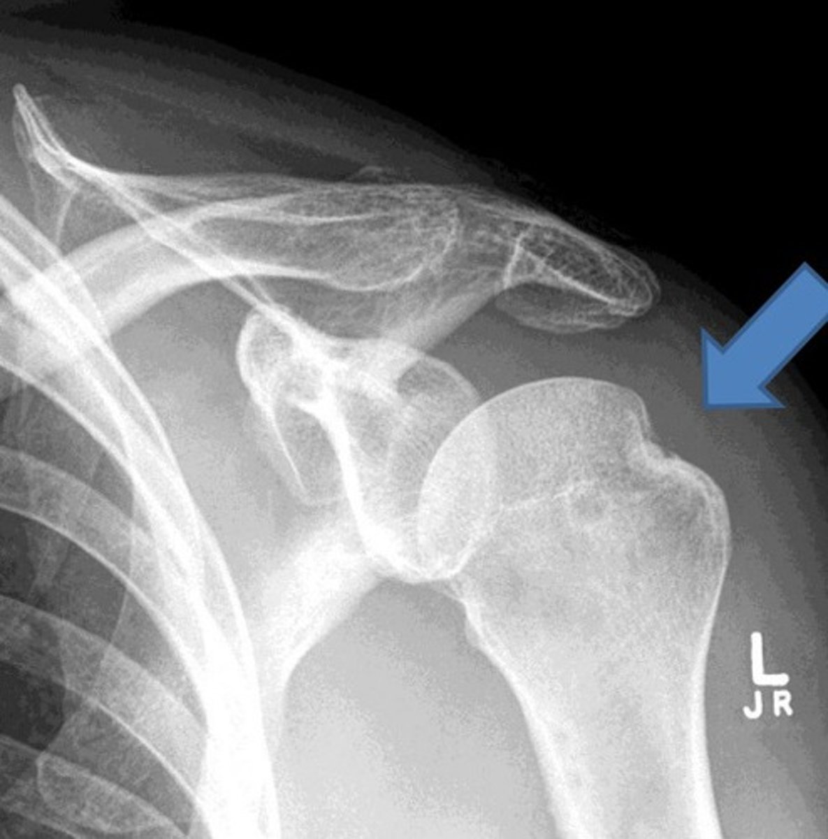 <p>- Compression fracture of the posterolateral humeral head</p><p>- Occurs during dislocation</p>
